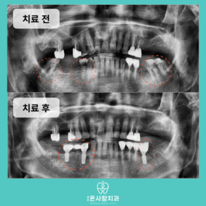 천호역임플란트추천