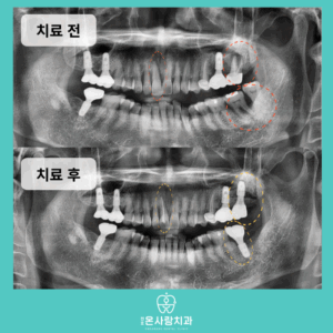 성내동임플란트