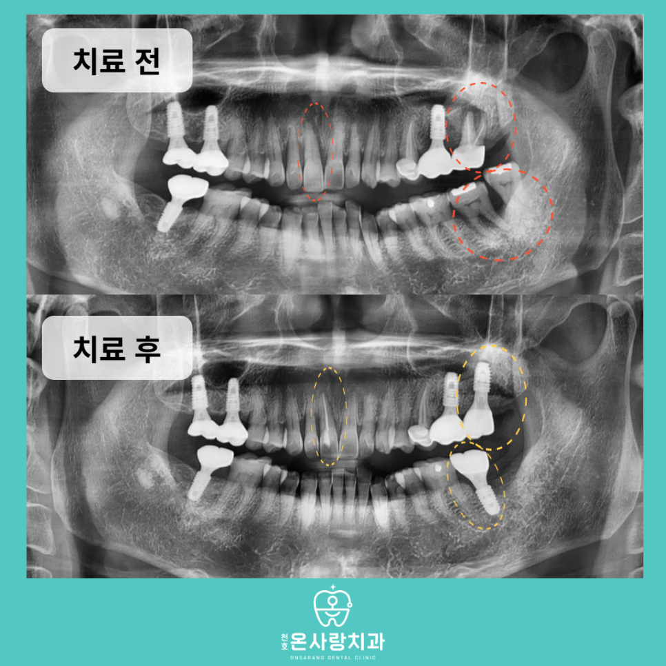 성내동임플란트