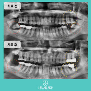 천호동임플란트추천