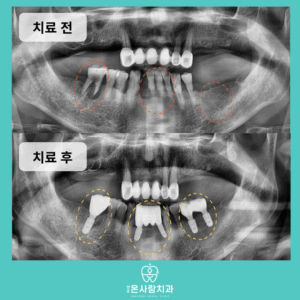 성내동치과잘하는곳