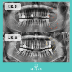 성내동임플란트추천