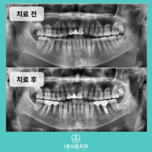 천호역임플란트