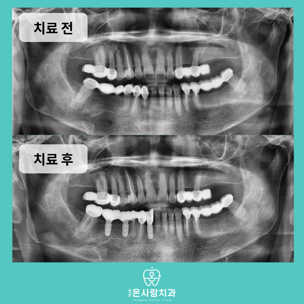 천호역임플란트