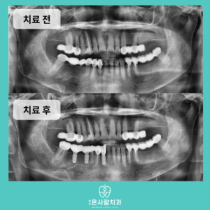 천호온사랑치과_증례전후탬플릿-복사본-_복사본