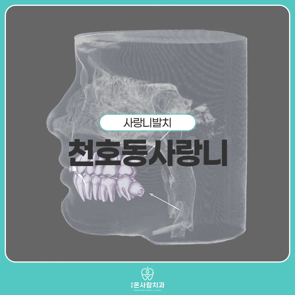 천호동사랑니